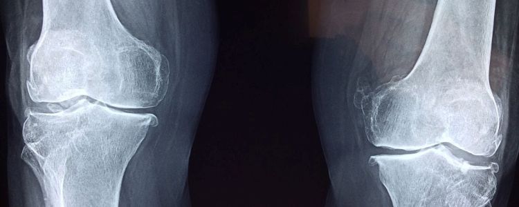Новий імплантат лікує зламані ноги, перетворюючись на справжню кістку