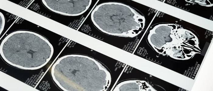 Десятиліття досліджень хвороби Альцгеймера спиралися на сфабриковані дані
