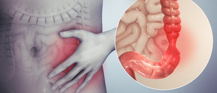 Синдром подразненого кишечника пов'язаний із мікропластиками в кишечнику