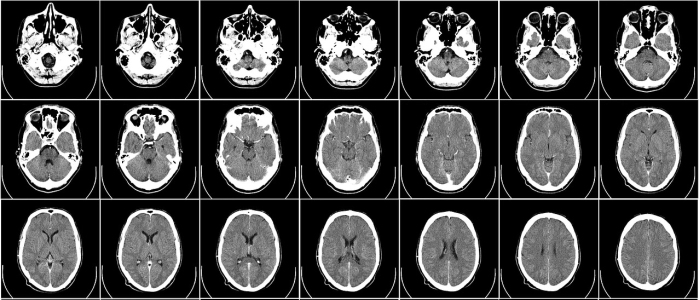 Лише одне сканування мозку тепер може діагностувати хворобу Альцгеймера