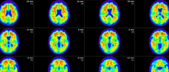Нові ліки проголошені «поворотним моментом» у боротьбі з хворобою Альцгеймера