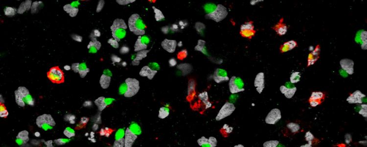Нове дослідження показує, що вірус Зіка вбиває стволові клітини раку мозку