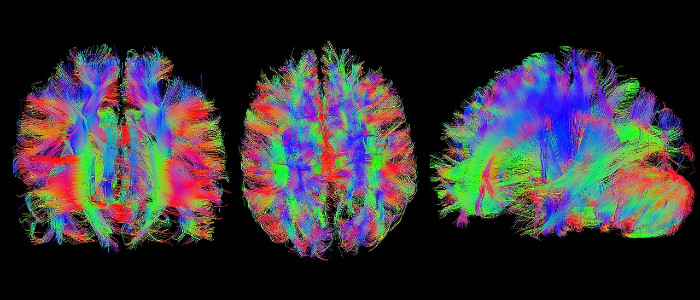 Стенфордські вчені кажуть, що магніти для мозку можуть полегшити депресію
