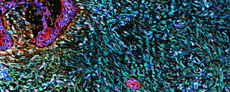 Ті, що вважалися відходами клітин, тепер можуть лікувати рак підшлункової залози