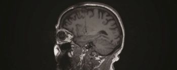 Мозкові клітини від свиней імплантовано в мозок людини для лікування хвороби Паркінсона