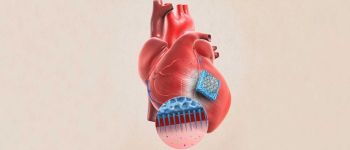 Пластир, покритий голками, може допомогти зцілити пошкоджені серця