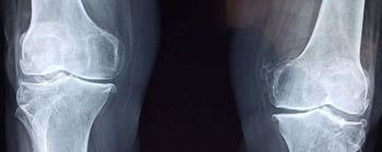 Новий імплантат лікує зламані ноги, перетворюючись на справжню кістку