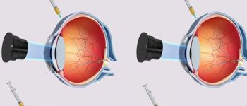 Новий нанобот доставить ліки у ваше очне яблуко