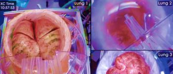 Медики лікують людські легені, приєднуючи їх до живих свиней