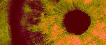 Генна терапія, введена в очне яблуко, відновлює зір сліпого пацієнта