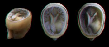 Тепер ми можемо зробити надточні 3D-моделі мозку пацієнтів